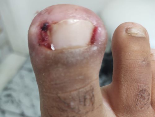 Onicocriptose Bilateral depois