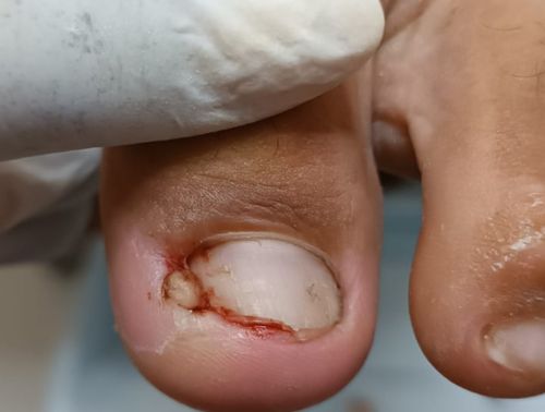 Onicocriptose-depois