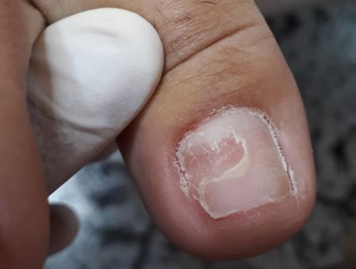 Reconstrução das unhas antes