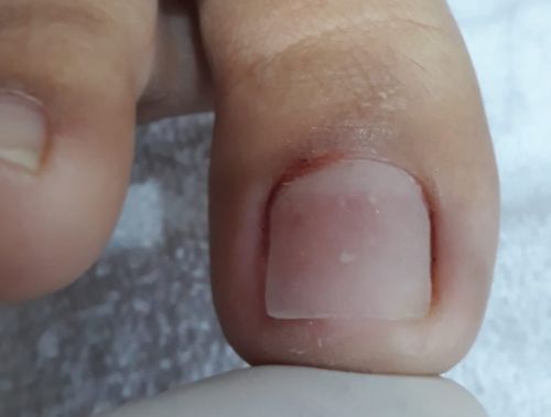 Reconstrução das unhas depois