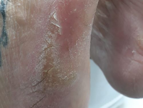 Ressecamento plantar antes