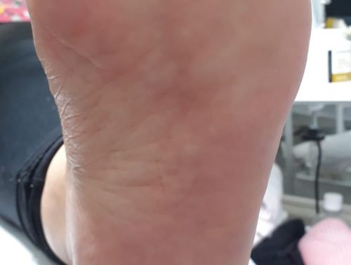 Ressecamento plantar depois 2