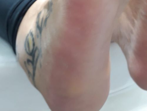 Ressecamento plantar depois