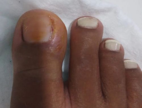 unha inflamada 3