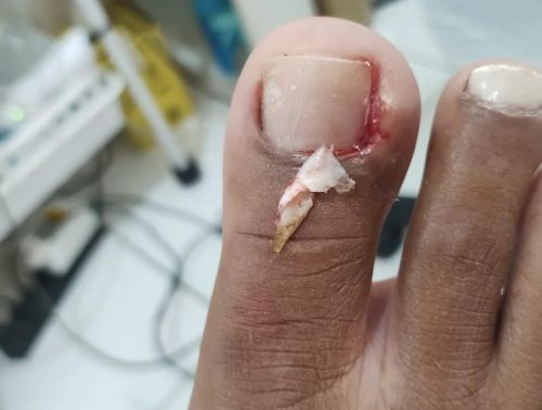 unha inflamada